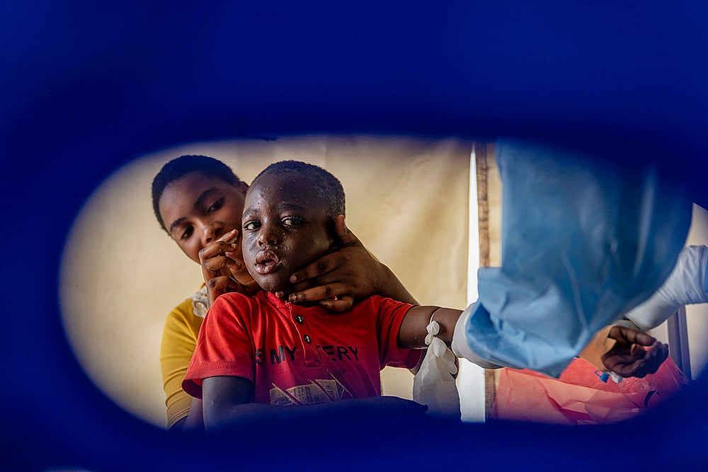 | Photo: AP/Moses Sawasawa : Mpox outbreak: A mpox patient in Congo